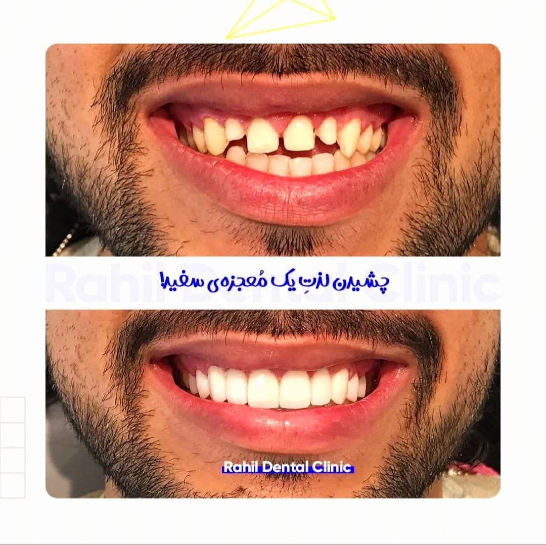 قبل و بعد کامپوزیت ونیر و لمینت سرامیکی دندان, دندانپزشکی زیبایی