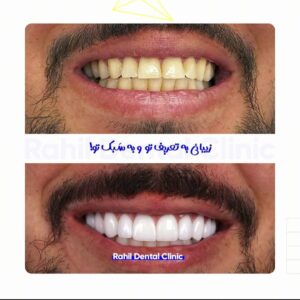 قبل و بعد کامپوزیت ونیر, دندانپزشکی زیبایی