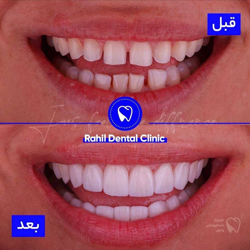 قبل و بعد کامپوزیت ونیر و لمینت سرامیکی دندان, دندانپزشکی زیبایی