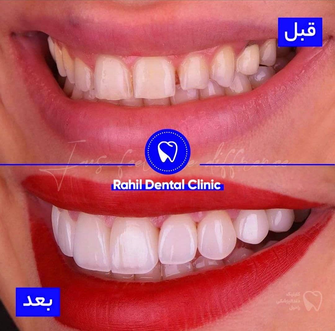 قبل و بعد کامپوزیت ونیر و لمینت سرامیکی دندان