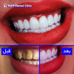 قبل و بعد کامپوزیت ونیر, دندانپزشکی زیبایی