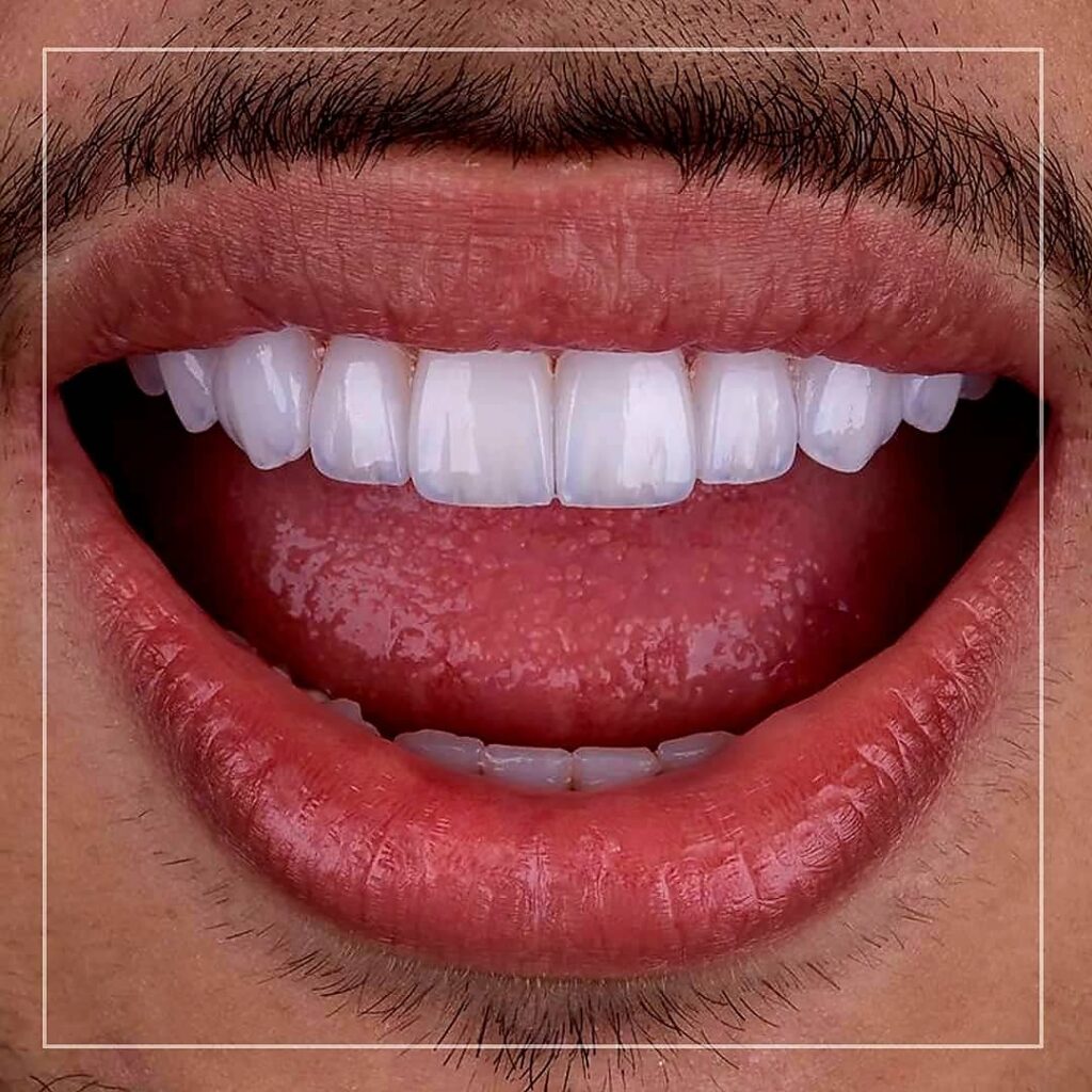 قبل و بعد کامپوزیت ونیر