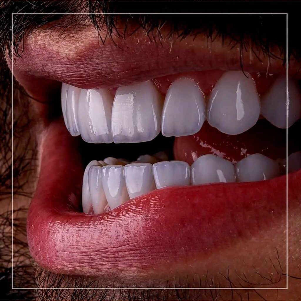 قبل و بعد کامپوزیت ونیر