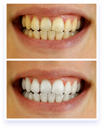 کلینیک دندانپزشکی راحیل, بلیچینگ دندان