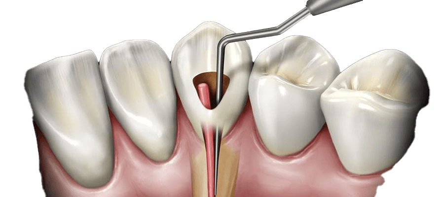 مرکز عصب کشی دندان