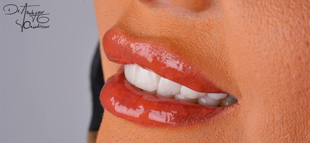 بهترین ونیر کامپوزیت دندان سعادت آباد