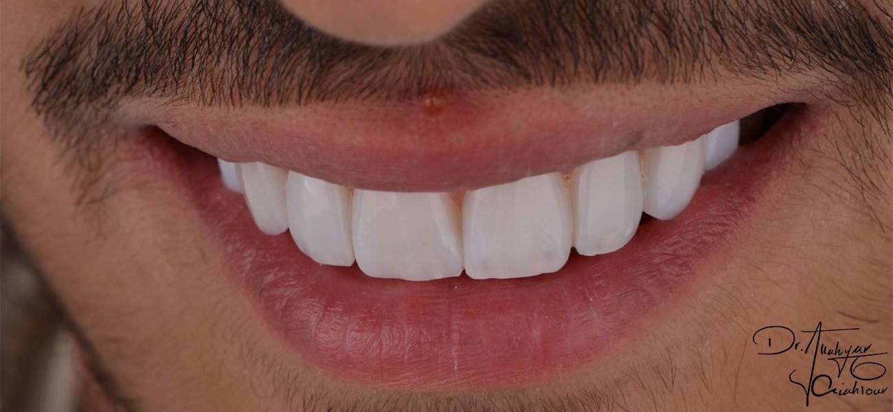 مرکز ونیر کامپوزیت دندان در شهرک غرب