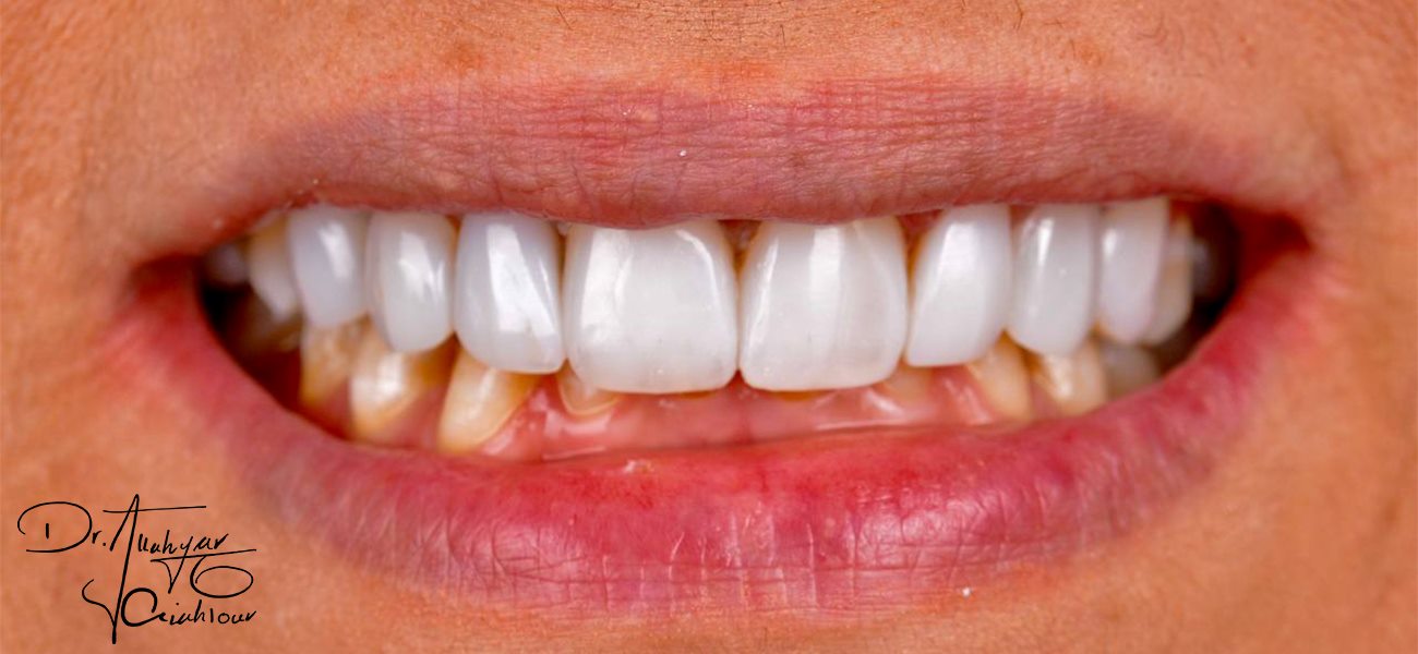 مرکز لمینت بدون تراش دندان