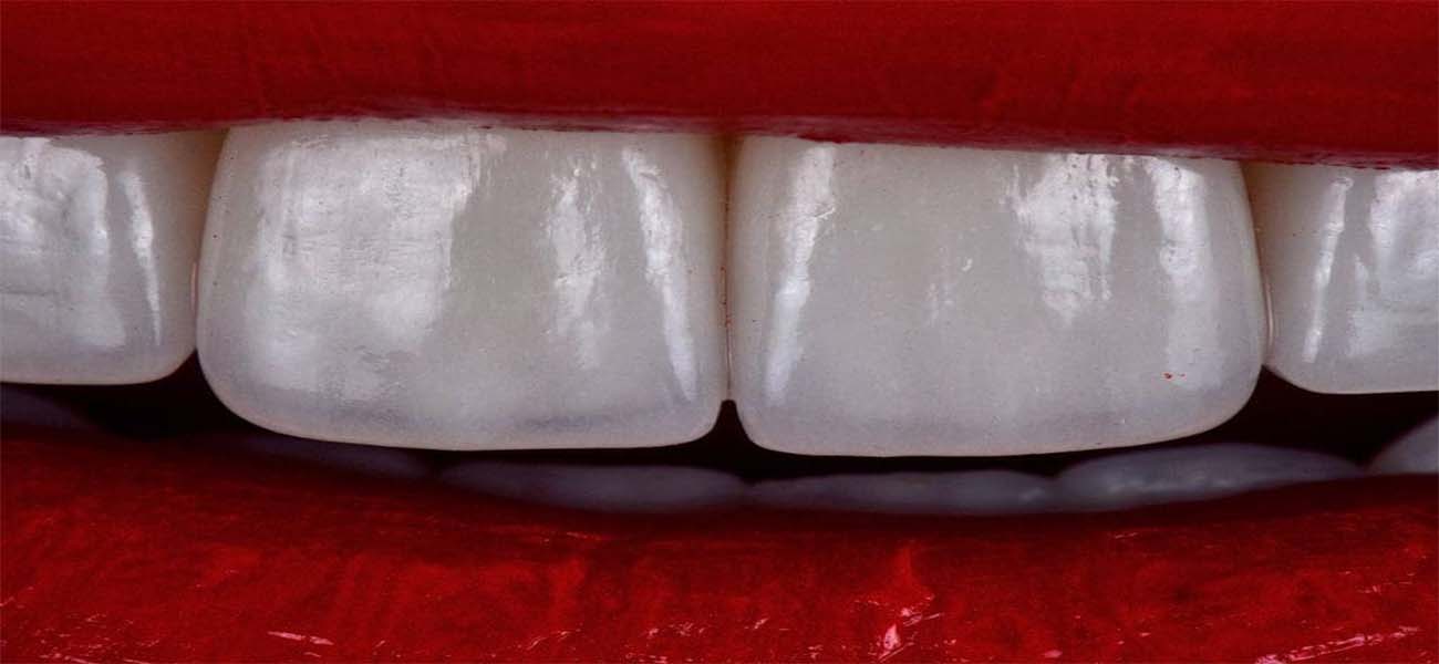 مزایا و معایب کامپوزیت دندان چیست؟