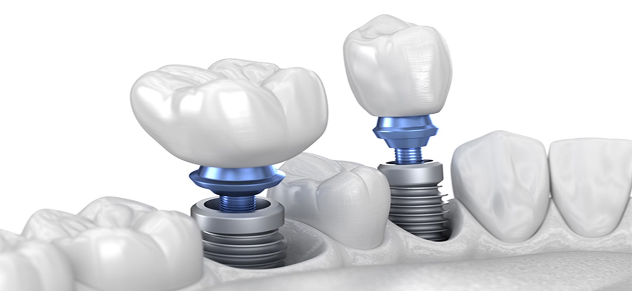 مرکز جراحی ایمپلنت دندان