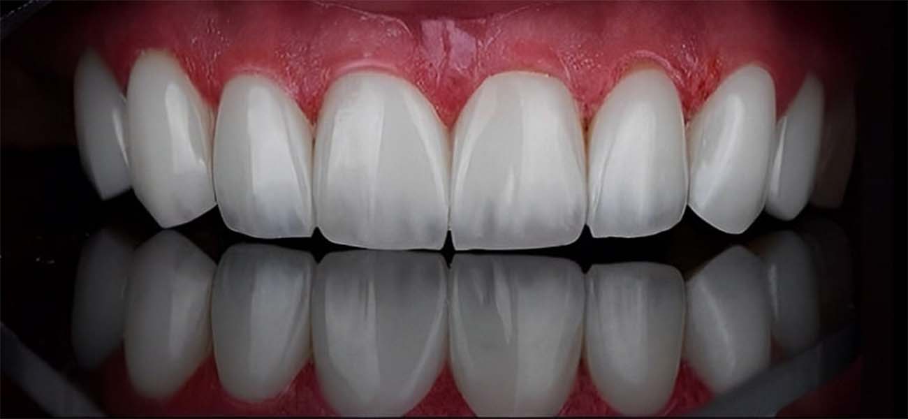 لمینت سرامیکی دندان چیست؟