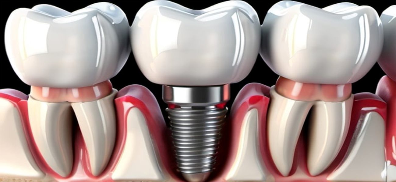 مرکز جراحی ایمپلنت دندان