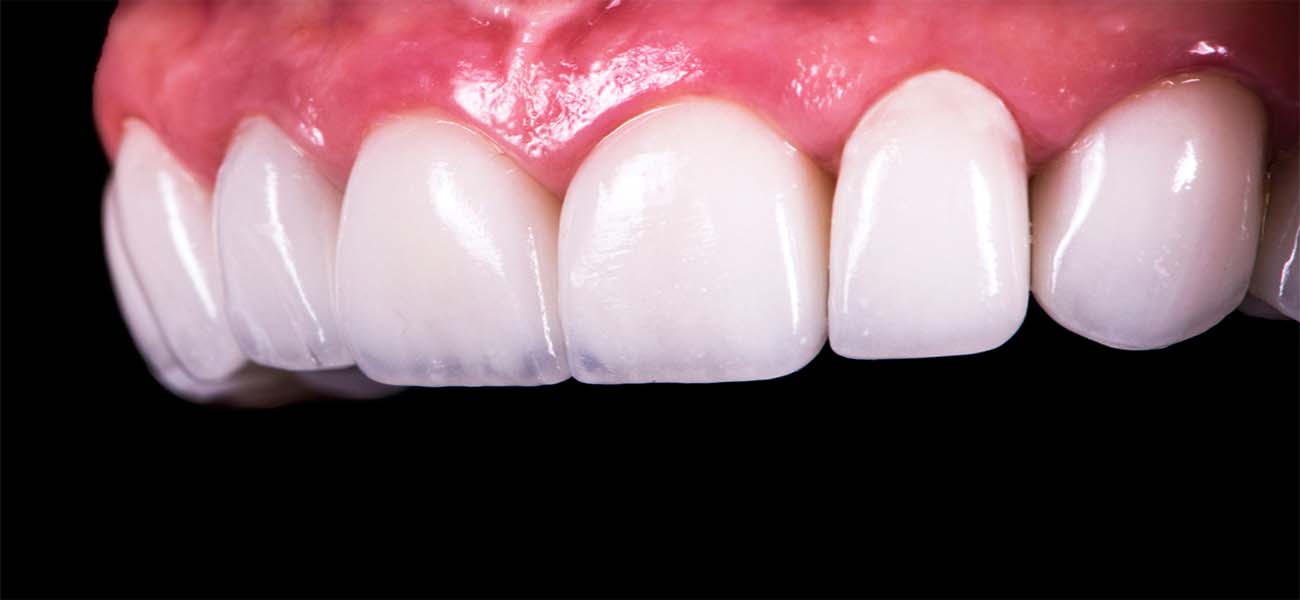 بهترین کامپوزیت دندان