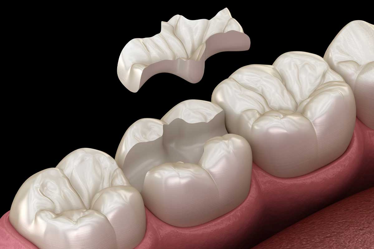 بهترین مواد ترمیمی دندان کدام است؟