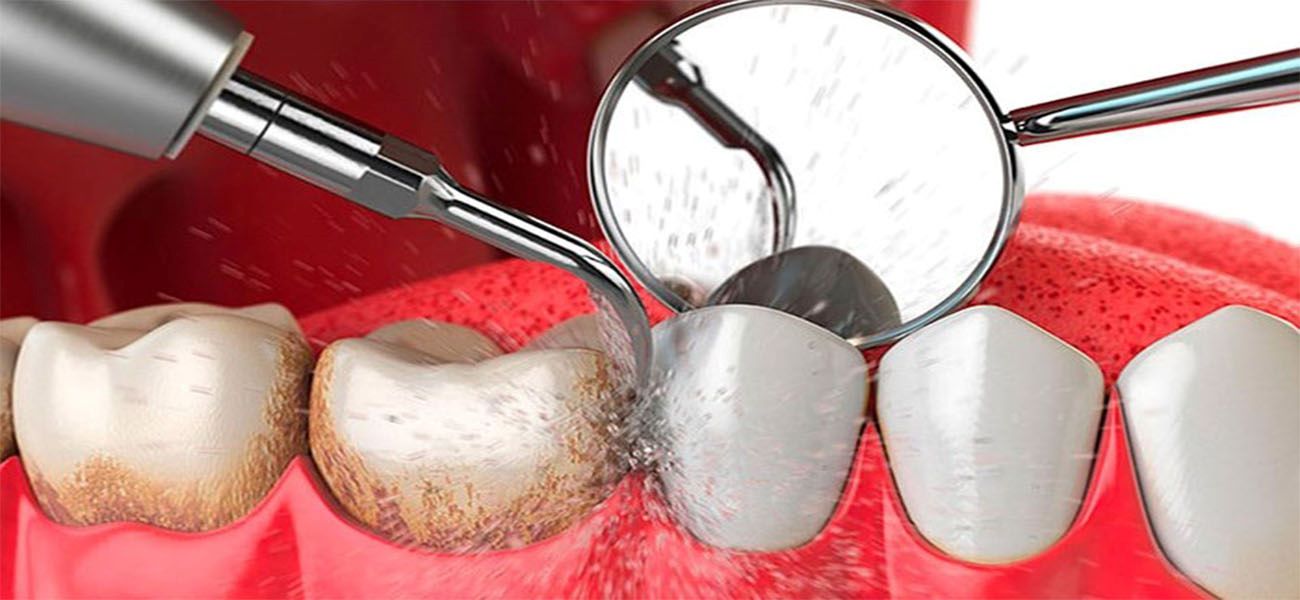 تفاوت عصب کشی و پر کردن دندان چیست؟