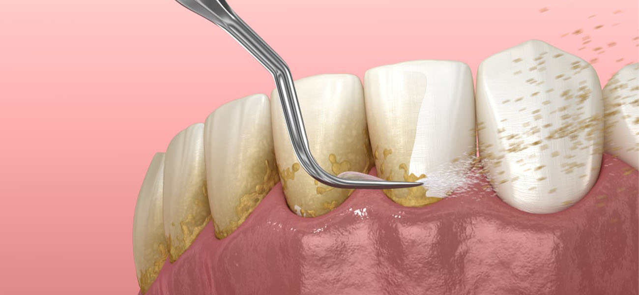 مرکز جرمگیری دندان